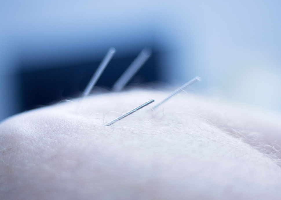 Dry Needling Acupunture Needles